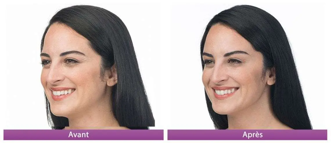 botox avant apres 1 droite