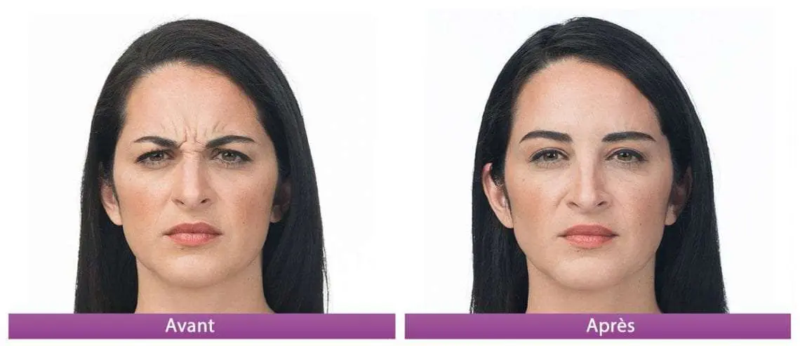 botox avant apres 1 front