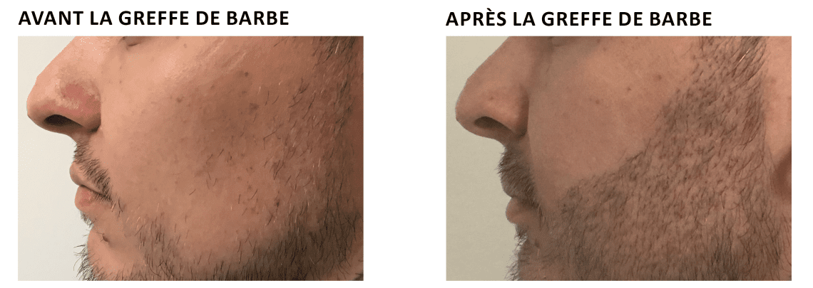 Greffe de Barbe - Implant de Barbe - Lazeo