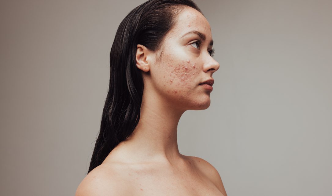 Acné et soleil : effets du soleil sur peau acnéique - Lazeo