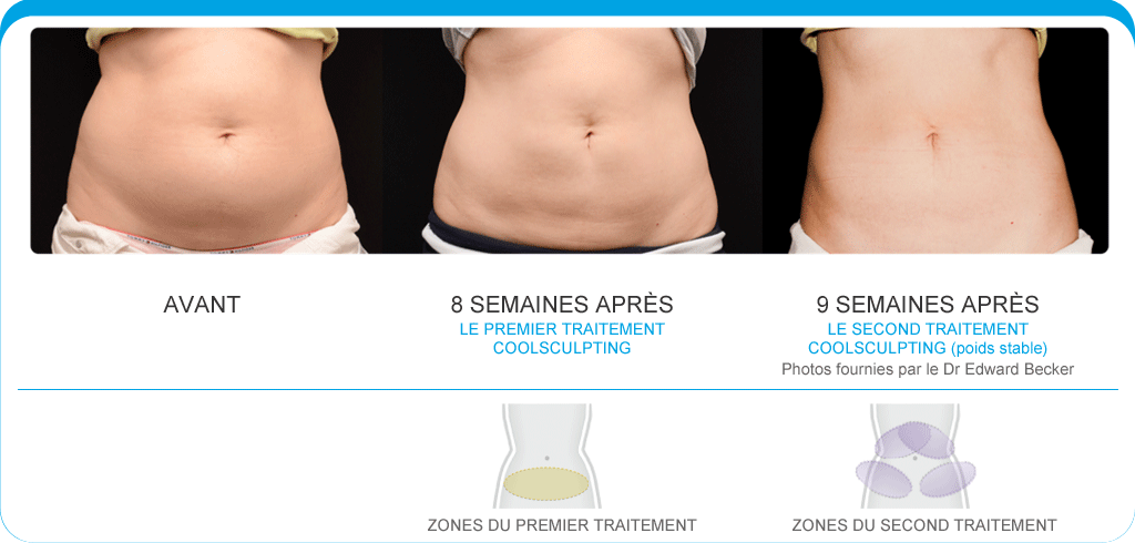 coolsculpting avant - apres 1
