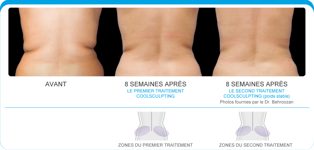 coolsculpting avant - apres 3
