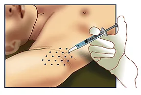 botox_injections_transpiration