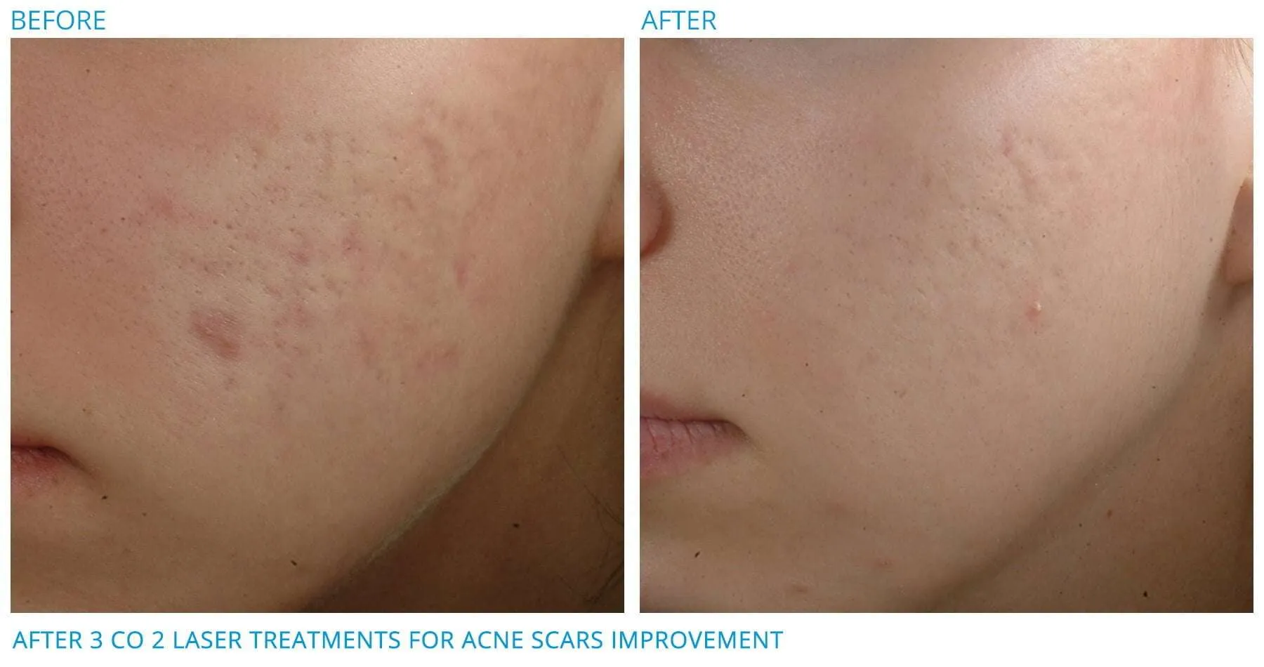Fractional clearance co2 laser