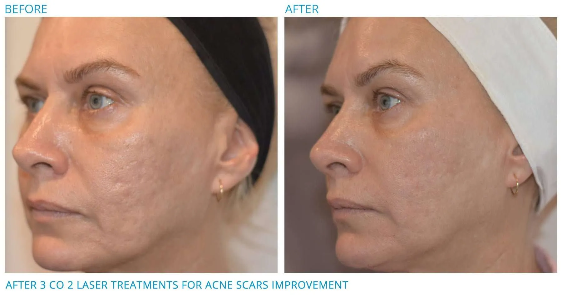 Fractional CO2 Laser Before and After Photos