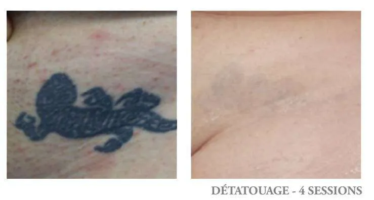 detatouage lyon lezard