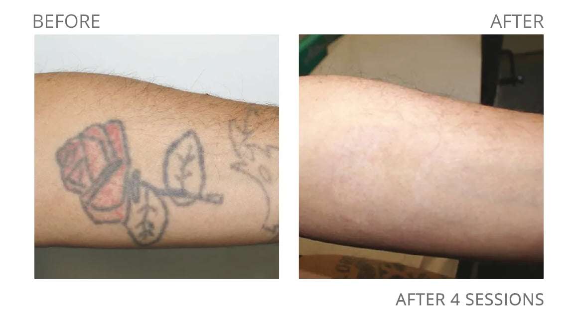 Tattoo removal with Discovery Pico Laser - LAZEO