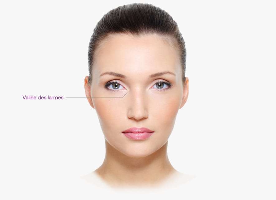 Injections pour les cernes