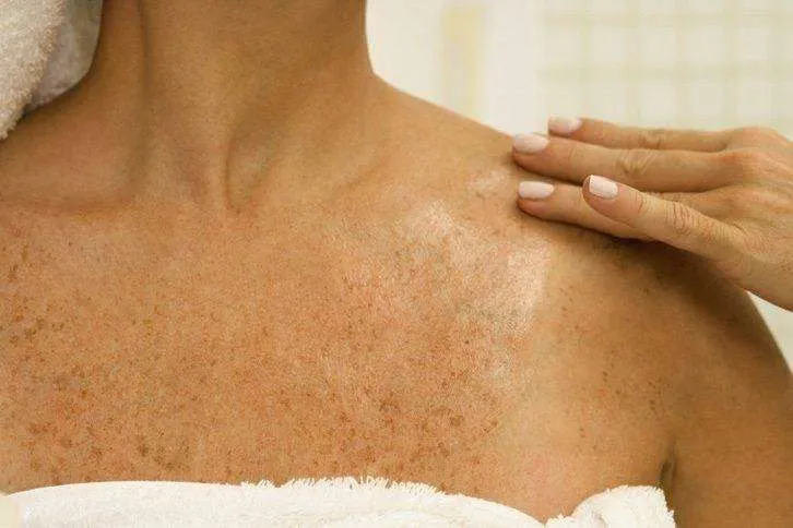 peau qui pèle