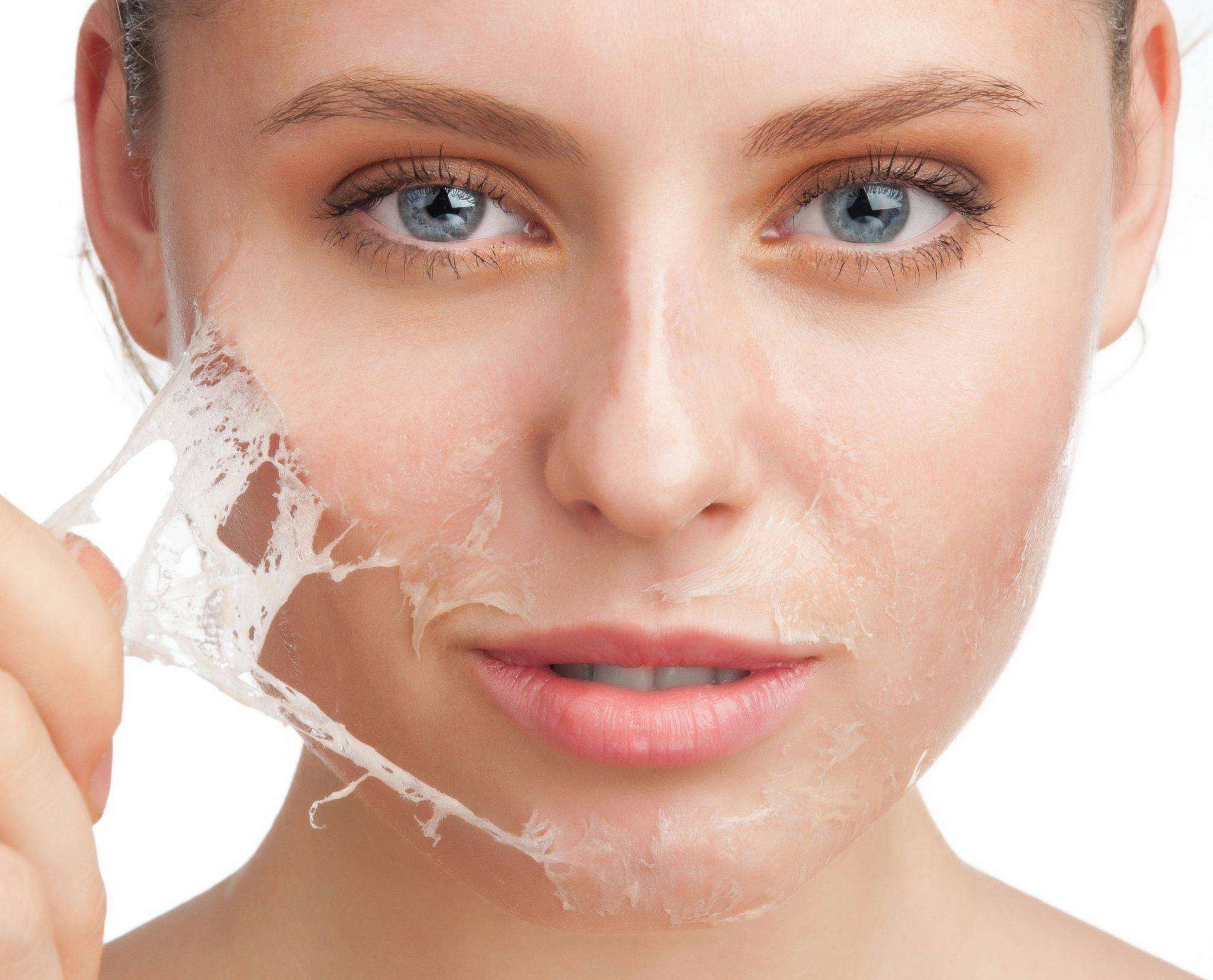 peeling superficiel