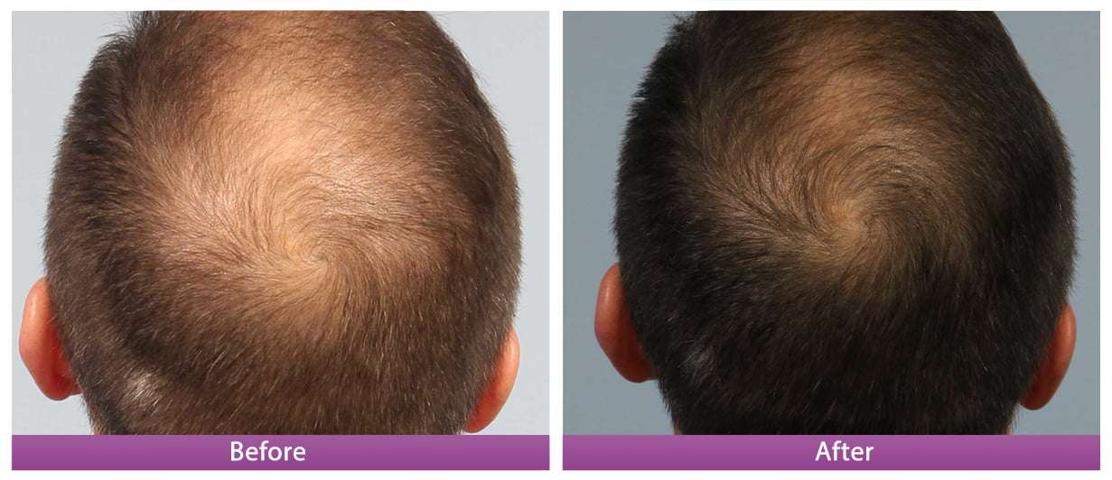 Stimulating hair growth with PRP - LAZEO Stimulating hair growth with PRP - LAZEO