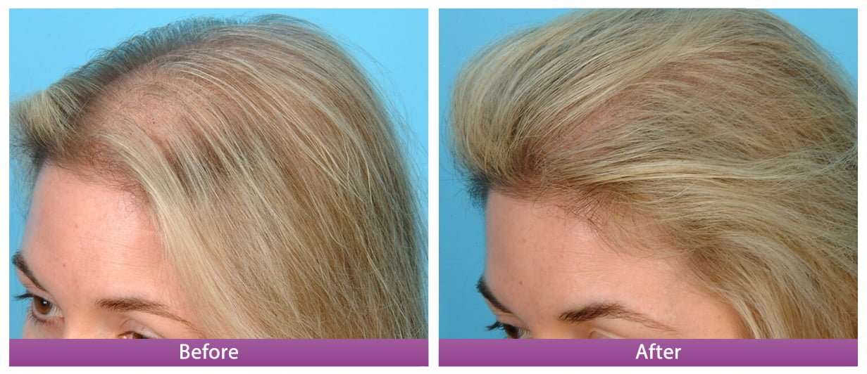 Stimulating hair growth with PRP - LAZEO