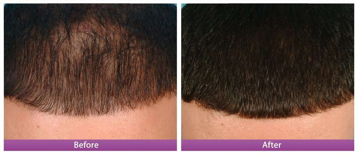 Stimulating hair growth with PRP - LAZEO